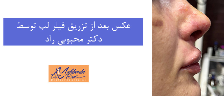 عکس بعد از فیلر لب دکتر محبوبی راد 
