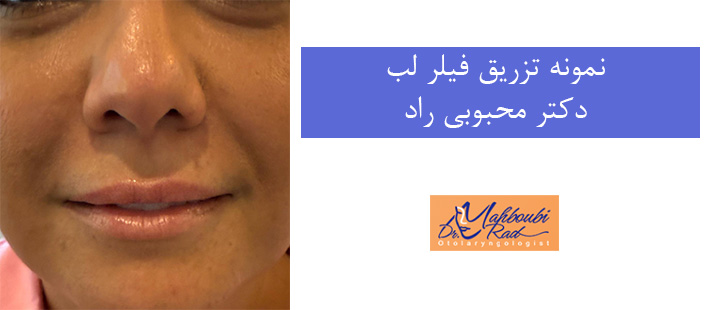 نمونه تزریق فیلر لب دکتر محبوبی راد 
