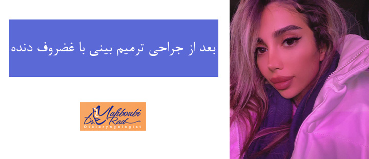 بعد از جراحی ترمیم بینی با غضروف دنده