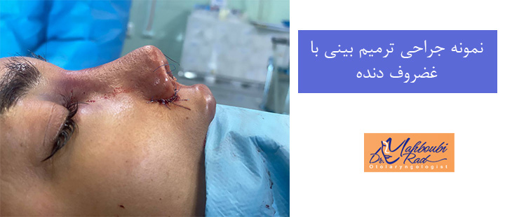 نمونه جراحی ترمیم بینی با غضروف دنده